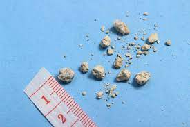 kidney stone