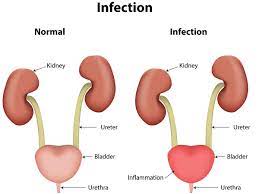 urinary tract infection