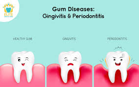 gingivitis disease