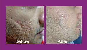 Laser skin resurfacing