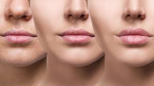 Lip augmentation