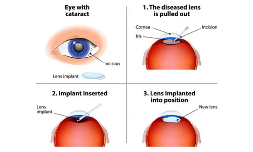 Small Incision Cataract Surgery Service, cataract 