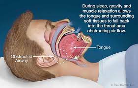 Snoring and sle