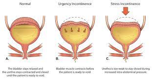 Urinary inconti