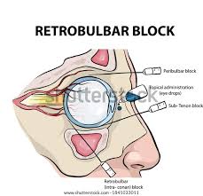 General Anesthesia.