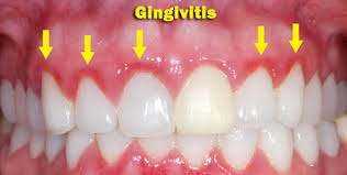 gingivitis disease