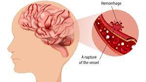 Hemorrhagic stroke