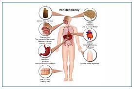 Iron Deficiency