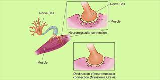 Myasthenia gravis