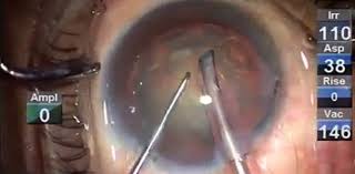 Small Incision Cataract Surgery Service, cataract 