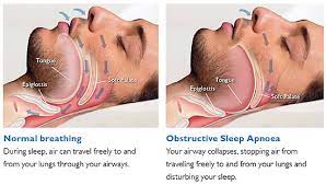 Snoring and sleep apnea