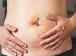 Soreness ,pain and swelling around the incision si