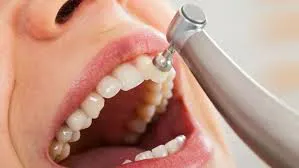 teeth cleaning