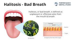 tongue halitosis bad breath