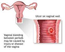 Unusual vaginal bleeding