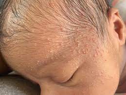 Baby sick problem diaper rash or cradle cap