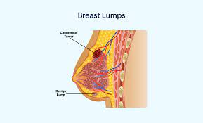 Breast Lumps