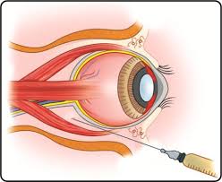 General Anesthesia.