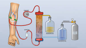 Haemodialysis