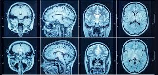 MRI (magnetic resonance imaging) scans