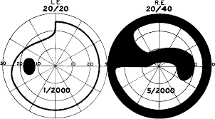 Paracentral Scotoma