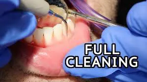 teeth cleaning