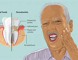 Chronic Periodontitis