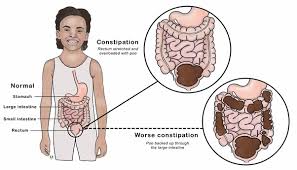 Constipation gas flatulence