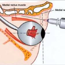 General Anesthesia.