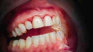 gingivitis disease