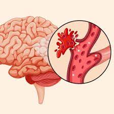 Hemorrhagic stroke