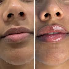 Lip augmentation