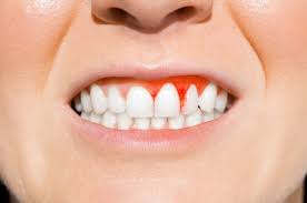 Periodontitis gum disease