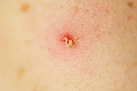 Pustules (small red bumps containing white or yell