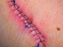 Soreness ,pain and swelling around the incision si