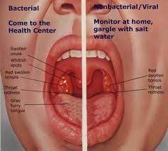 Tonsillitis